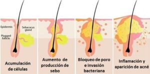 Acné y alimentación: cómo lo que comes influye en tu piel 1 progresionacne