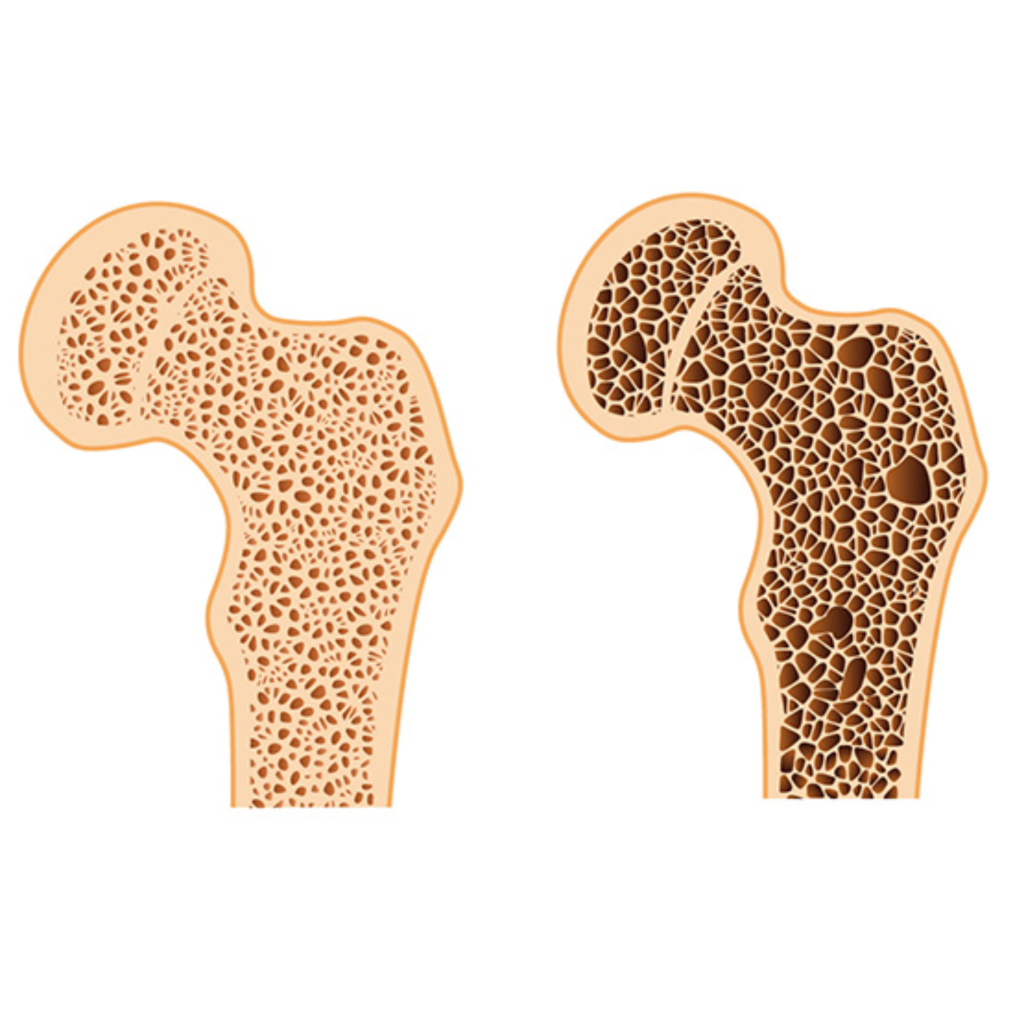 Osteoporosis